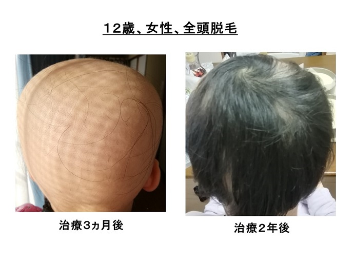 円形脱毛症　病院